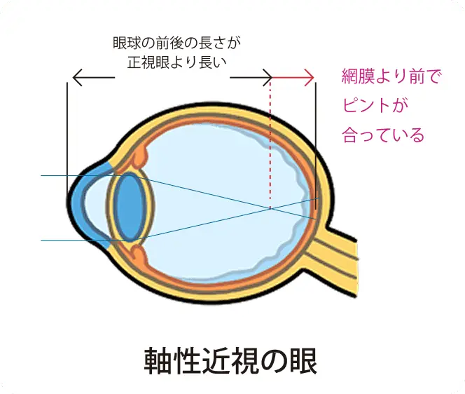 近視の説明図1