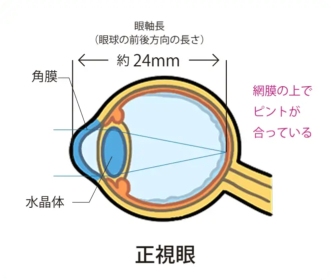 近視の説明図2